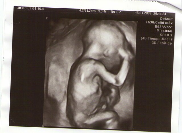 Primera ecografia meva 3D