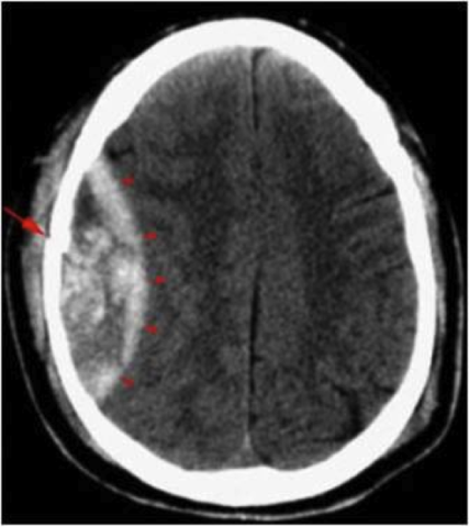 Mi conmoción cerebral