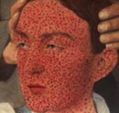Identification of smallpox