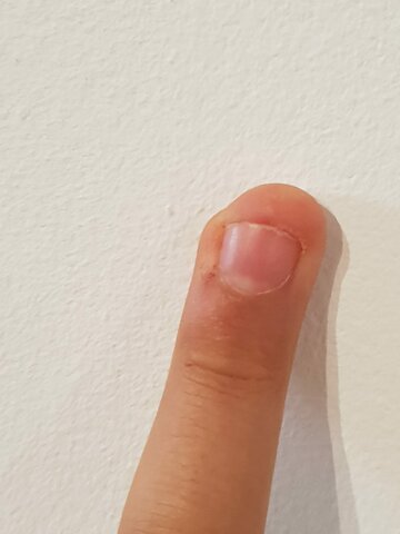 Em vaig enganxar el dit en una porta