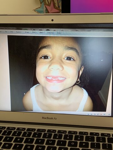 Mis dos dientes frontales se fueron