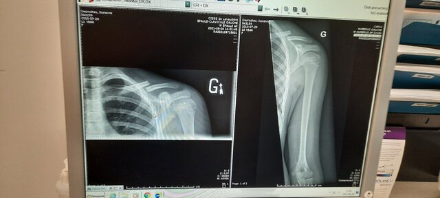 ma cassure de clavicule
