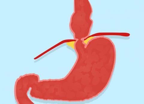 Detección y tratamiento de Hernia Hiatal