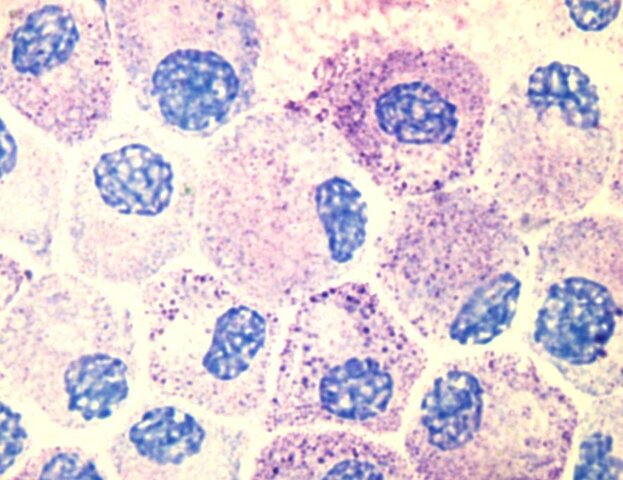 Inflamación crónica- Mastocitos