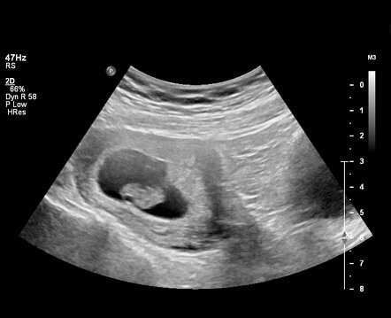 1st Trimester