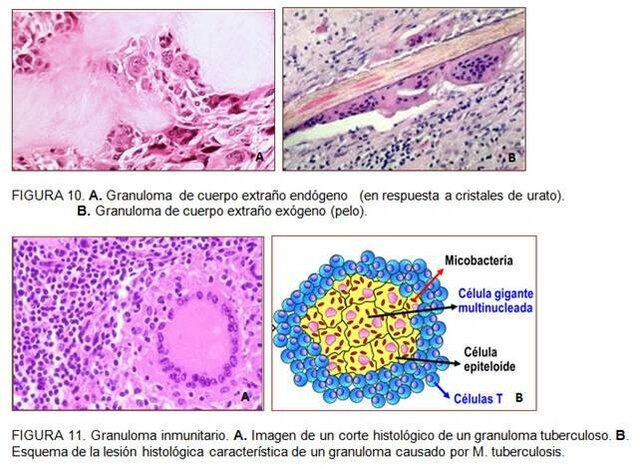 Inflamación crónica proliferativa