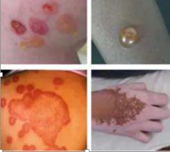 Factores que afectan el proceso de curación