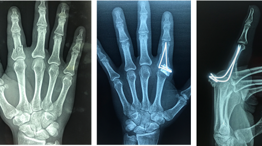 My first broken bone