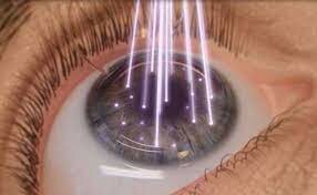 Operaciones con láser