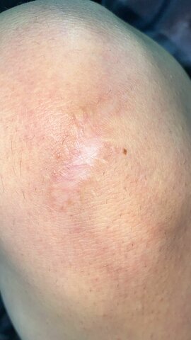 TUVE UN ACCIDENTE Y ME ABRI LA RODILLA