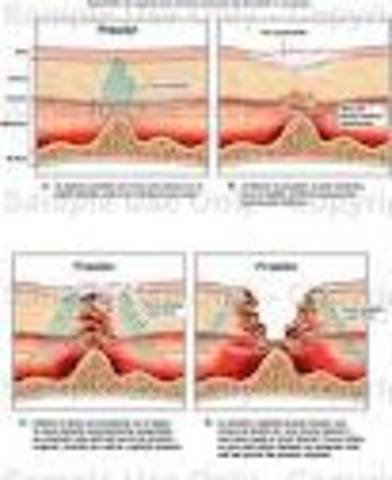 SEXTO Y ULTIMO ESTADIO DE ULCERACION