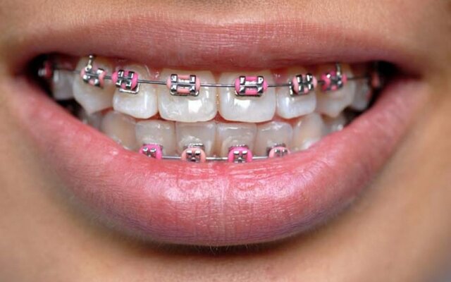 Me pusieron brackets