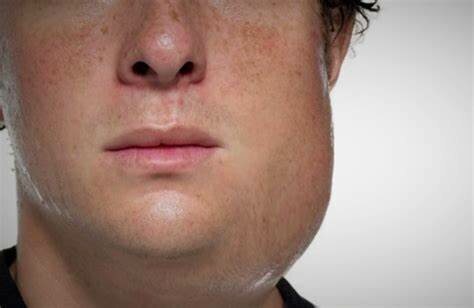 Sarampión, paperas y tabardillo