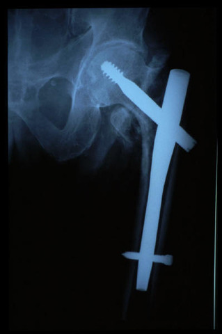 MATERIAL OSTEOSINTESIS