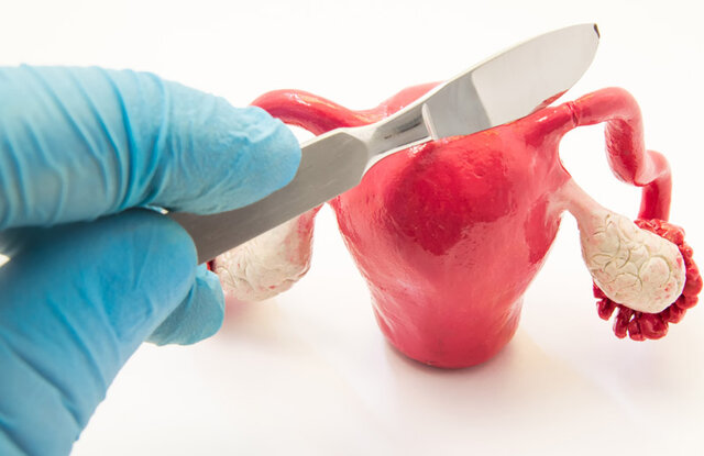 Se acepta la salpingoclasia.