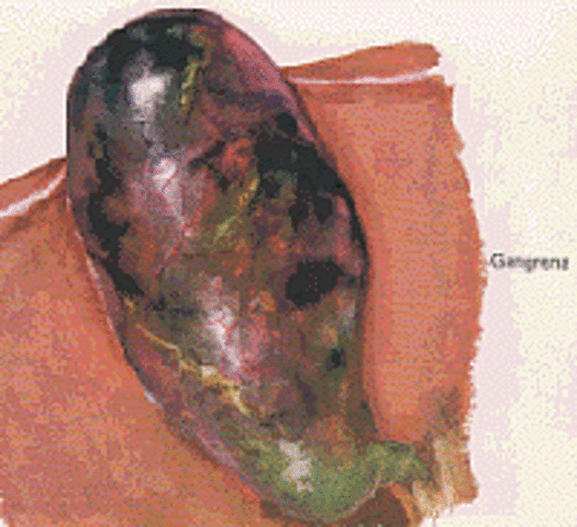 •    Complicaciones