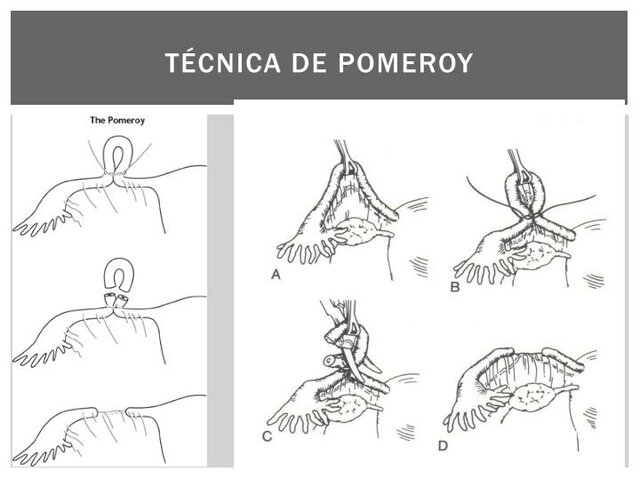 Nueva técnica quirúrgica