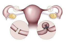Primera salpingoclasia