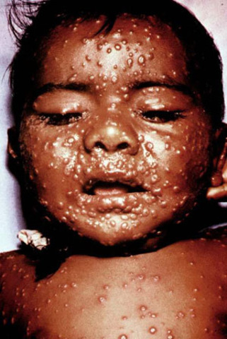 Small Pox eradicated