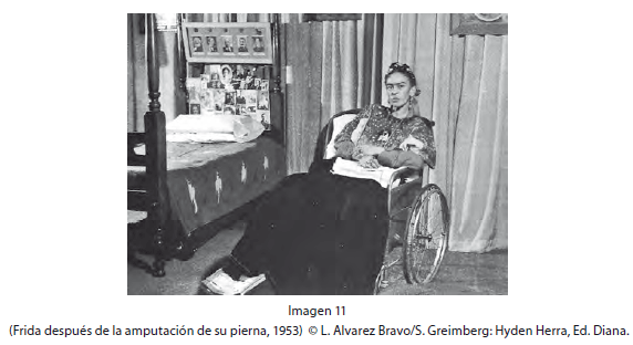 Frida has her leg amputated due to gangrene