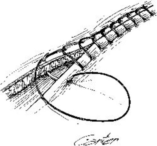 Lister’’s research on the prevention of wound suppuration