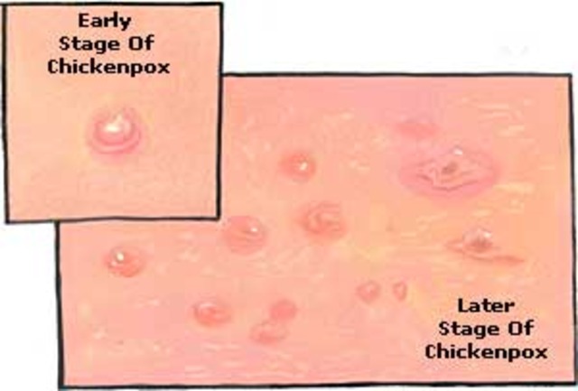 The chicken pox