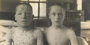 distinguished between smallpox and measles