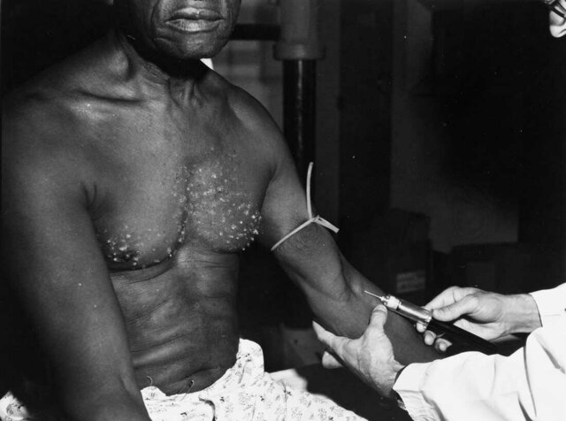 Tuskegee Syphilis study
