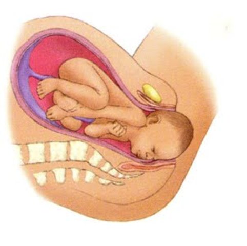 When the top of the head appears at the opening of the birth canal, it is called crowning