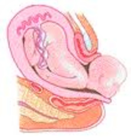 Second Stage of Labor: Head Emerges