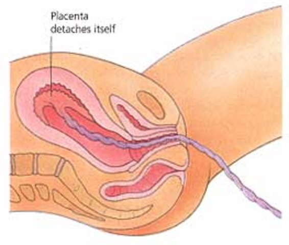 Delivering the Placenta