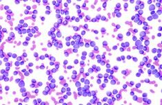 Tuberculosis y Fiebre tifoidea