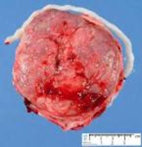 Third Stage of Labor