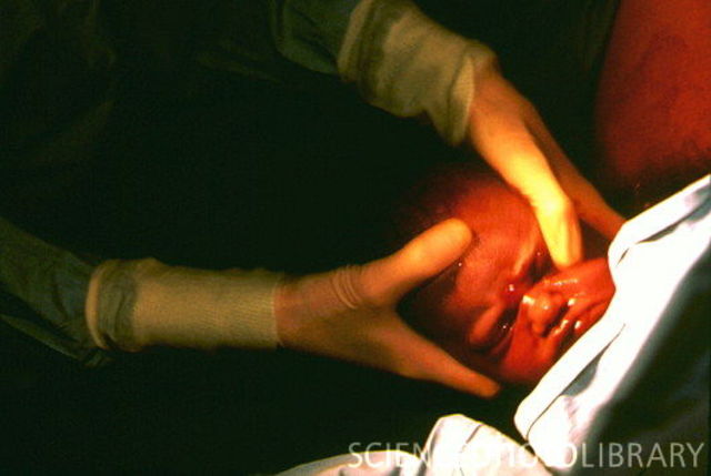 Head emerges followed by the shoulders