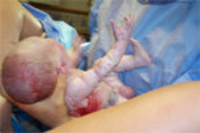 Rest of the baby follows easily.