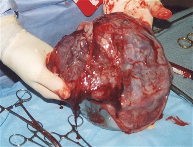 Woman gives birth to placenta.