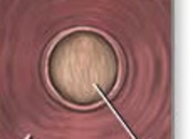 The first stage of labor--contractions make the cervix dilate