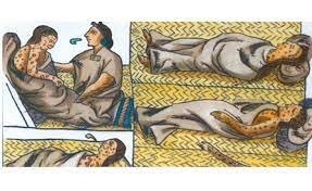 Epidemia de sarampión