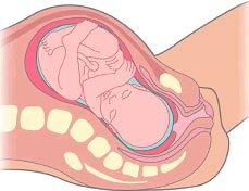 Primera etapa del parto