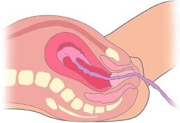 Tercera etapa del parto