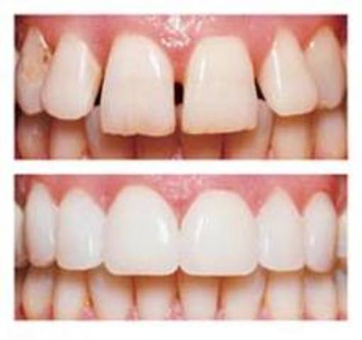 Dental Veneers