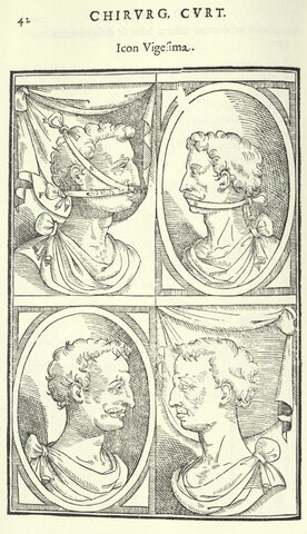 Gaspari Taliacotti (1545-1599)