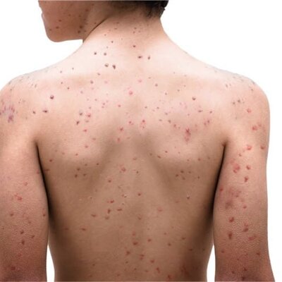 Timeline: La Viruela