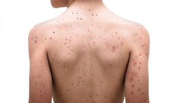 Timeline: La Viruela