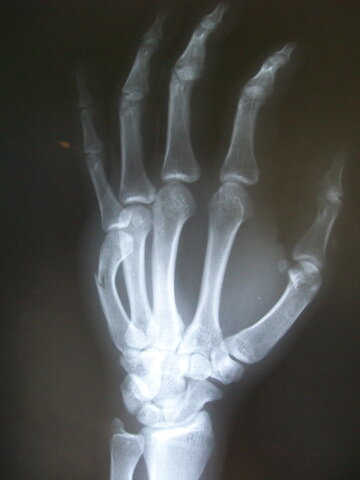 Fractured my left hand