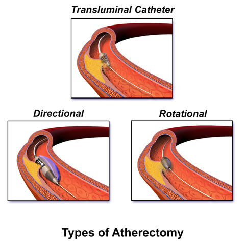 Patent for his Embolectomy Catheter filed