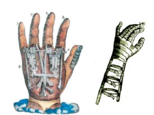 Ambroise Paré Prótesis más conocida