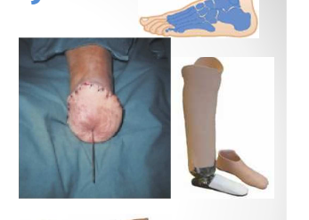 Nuevo método de amputación