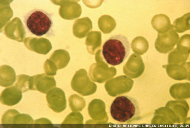 John Moore sues for compensation on commercial cell line created without his consent