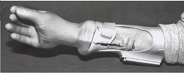 Prótesis activada por la contracción muscular